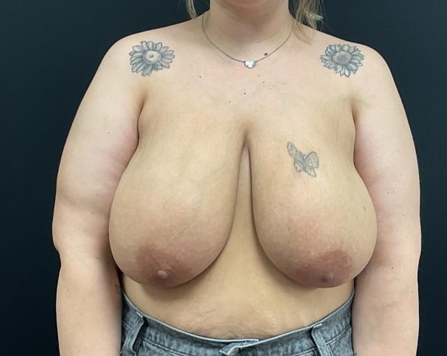 Breast Reduction before at Plastic Surgery Center in Wichita, KS