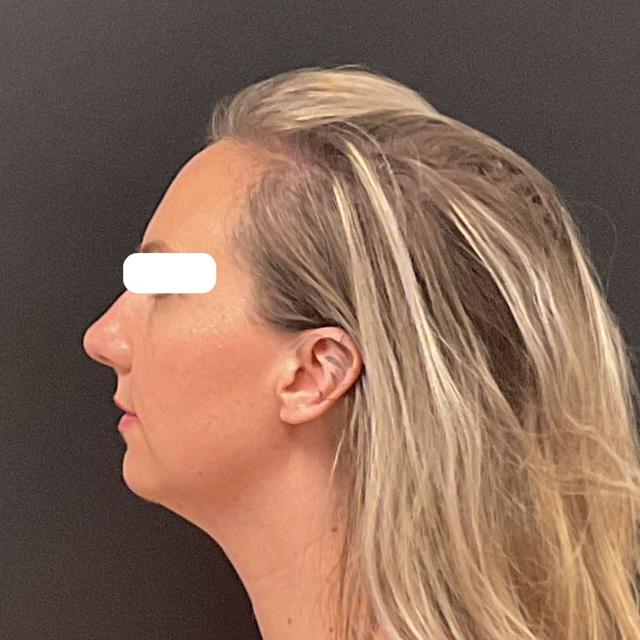 Functional Rhinoplasty before at Plastic Surgery Center in Wichita, KS