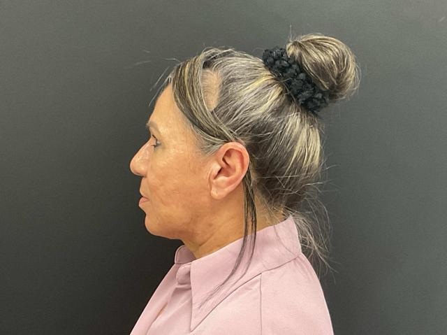 Facelift after at Plastic Surgery Center in Wichita, KS