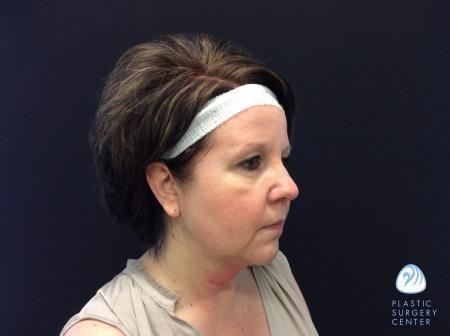 Chemical Peel before at Plastic Surgery Center in Wichita, KS