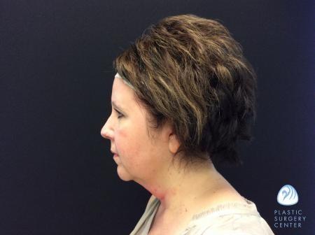 Chemical Peel before at Plastic Surgery Center in Wichita, KS