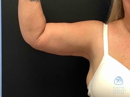 Arm Lift after at Plastic Surgery Center in Wichita, KS