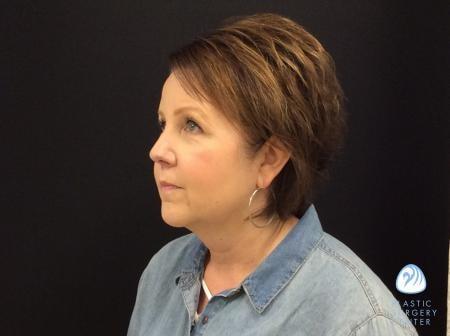 Chemical Peel after at Plastic Surgery Center in Wichita, KS