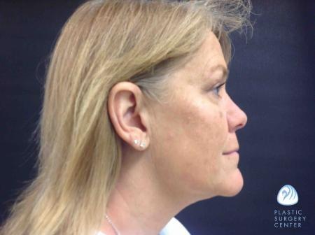 Chemical Peel after at Plastic Surgery Center in Wichita, KS