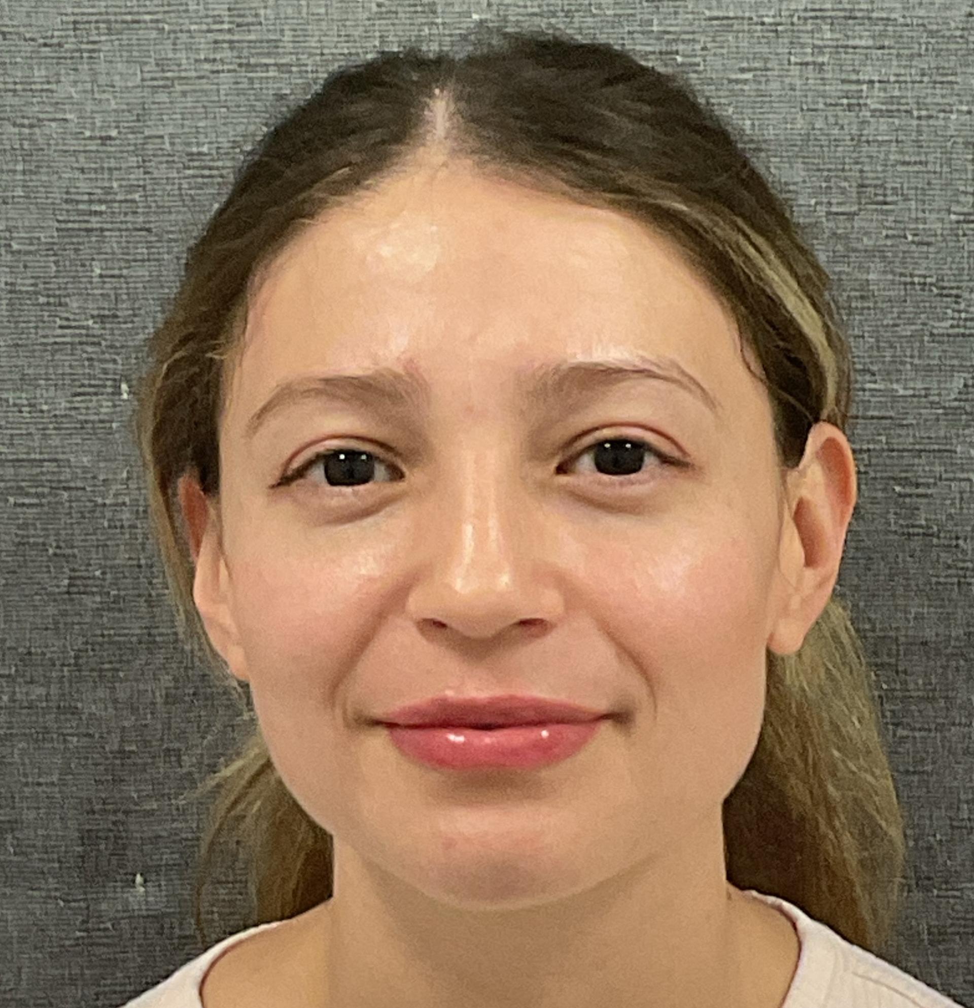 Plastic Surgery Center lip filler after — Wichita, KS