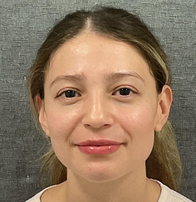 Juvederm after at Plastic Surgery Center in Wichita, KS