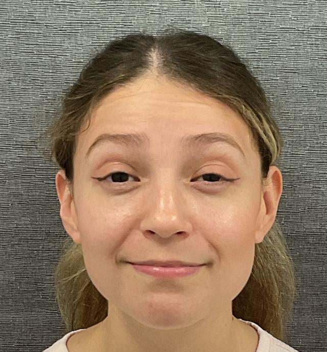 Juvederm before at Plastic Surgery Center in Wichita, KS