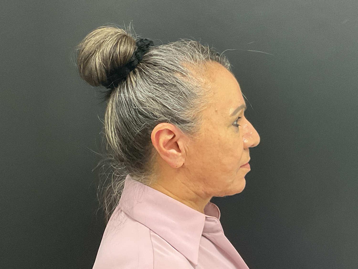 Plastic Surgery Center after — Wichita, KS