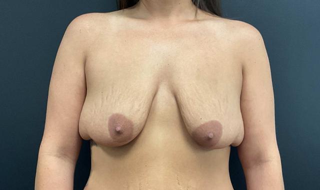 Mini Tummy Tuck before at Plastic Surgery Center in Wichita, KS