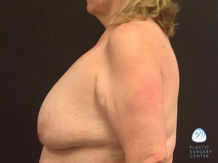 Breast Lift before at Plastic Surgery Center in Wichita, KS