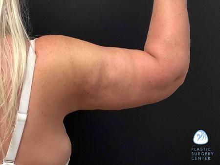 Arm Lift after at Plastic Surgery Center in Wichita, KS