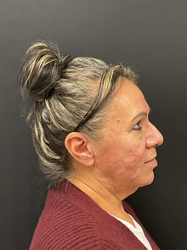Facelift before at Plastic Surgery Center in Wichita, KS