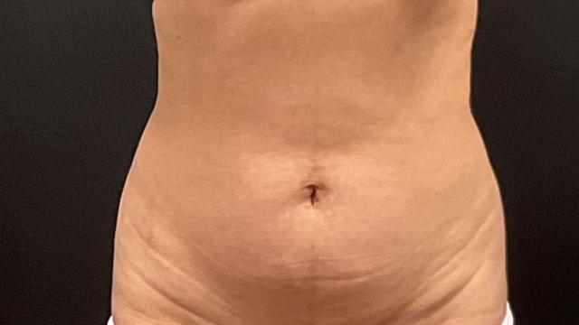 Mini Tummy Tuck before at Plastic Surgery Center in Wichita, KS