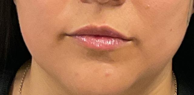 Lip Filler before at Plastic Surgery Center in Wichita, KS