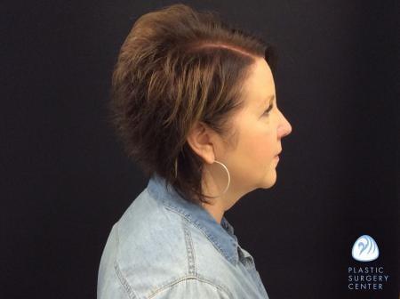 Chemical Peel after at Plastic Surgery Center in Wichita, KS