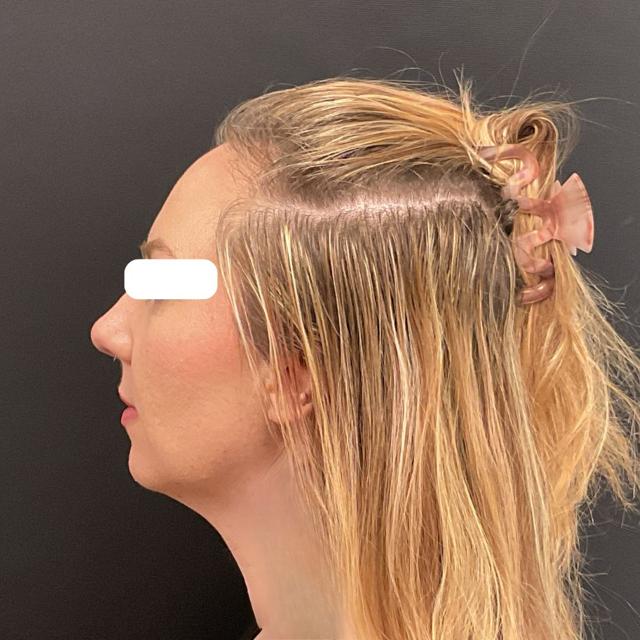 Functional Rhinoplasty after at Plastic Surgery Center in Wichita, KS
