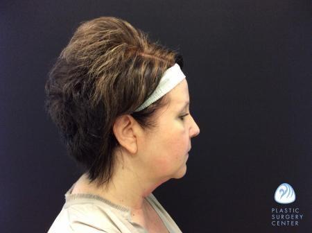 Chemical Peel before at Plastic Surgery Center in Wichita, KS
