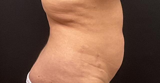 Mini Tummy Tuck before at Plastic Surgery Center in Wichita, KS