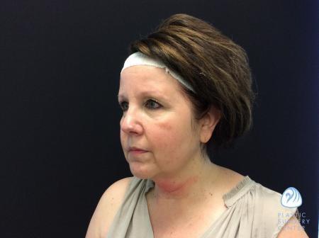 Chemical Peel before at Plastic Surgery Center in Wichita, KS