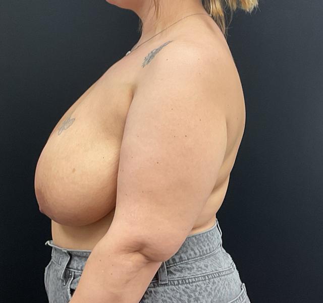 Breast Reduction before at Plastic Surgery Center in Wichita, KS
