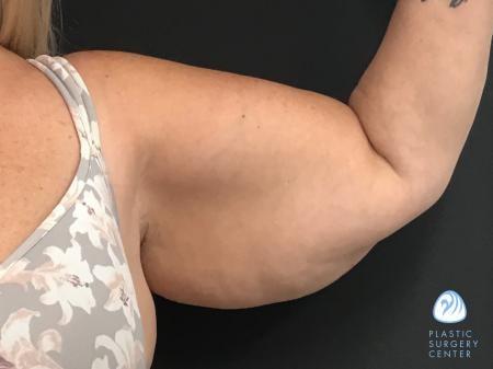 Arm Lift before at Plastic Surgery Center in Wichita, KS