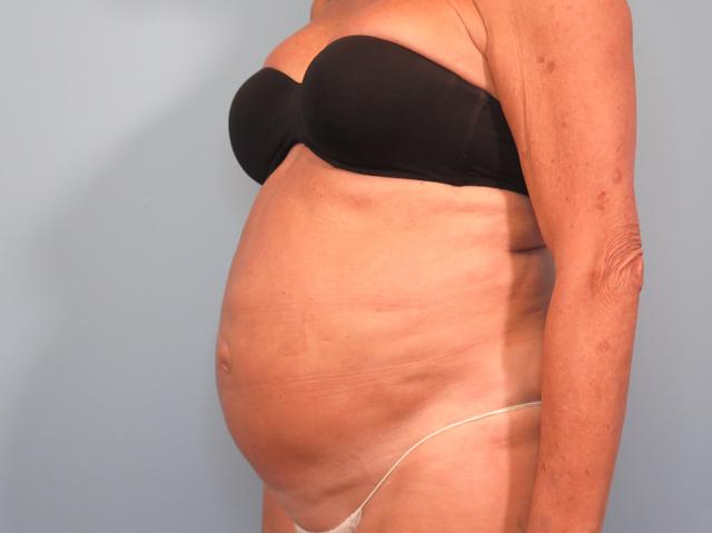 Tummy Tuck before at Dr. Brad Denney, MD, FACS in Mountain Brook, AL