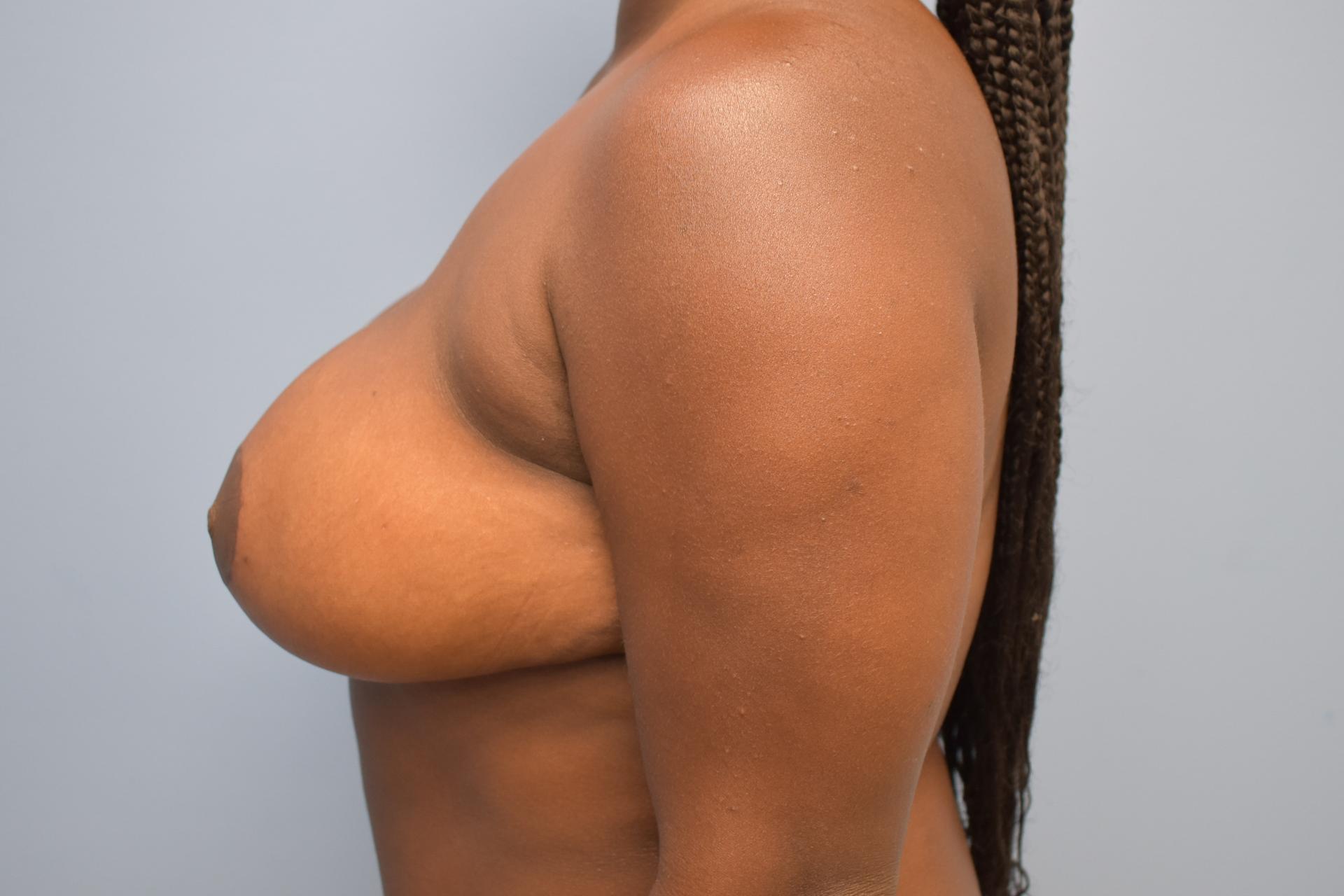 Dr. Brad Denney, MD, FACS after — Mountain Brook, AL