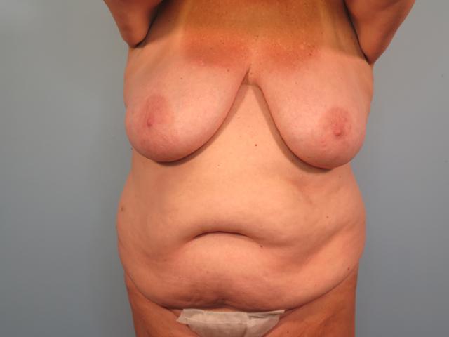 Tummy Tuck before at Dr. Brad Denney, MD, FACS in Mountain Brook, AL
