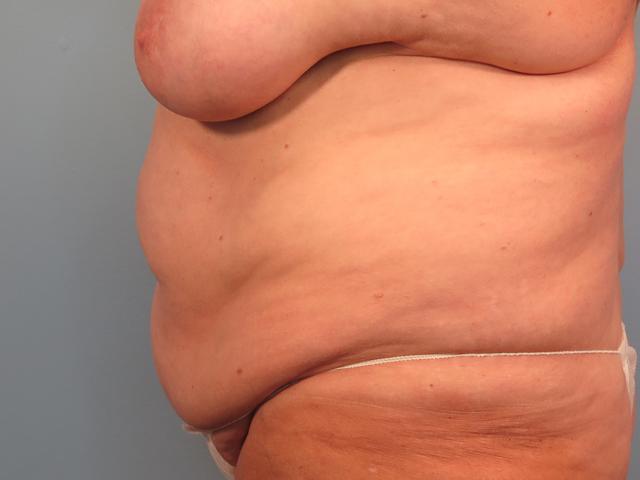 Tummy Tuck before at Dr. Brad Denney, MD, FACS in Mountain Brook, AL