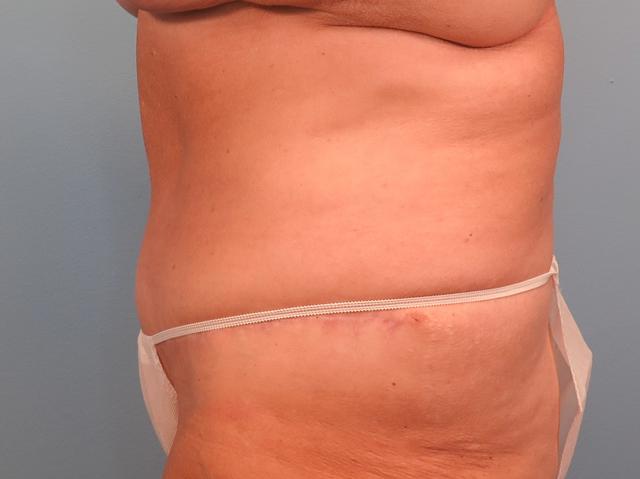Tummy Tuck after at Dr. Brad Denney, MD, FACS in Mountain Brook, AL