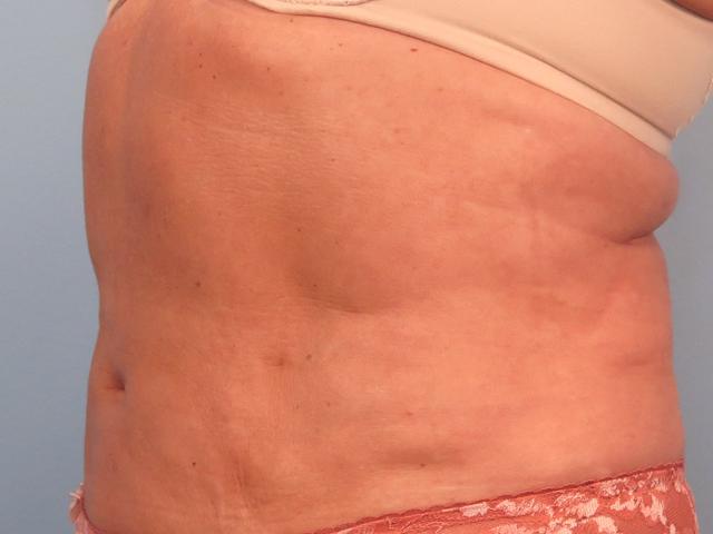 Tummy Tuck after at Dr. Brad Denney, MD, FACS in Mountain Brook, AL