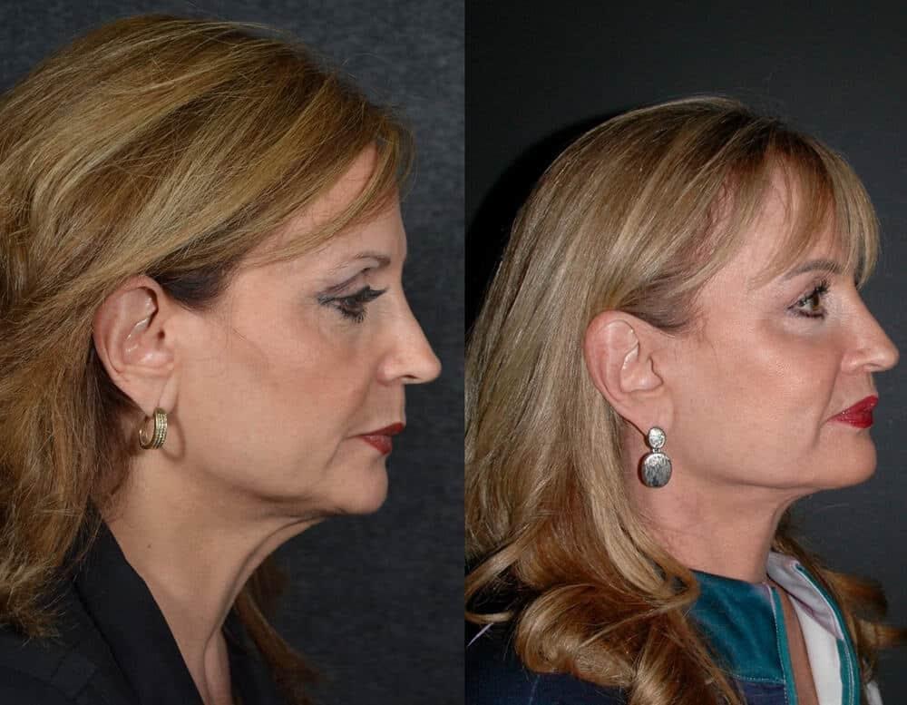 David W. Kim, MD facelift result — San Francisco, CA