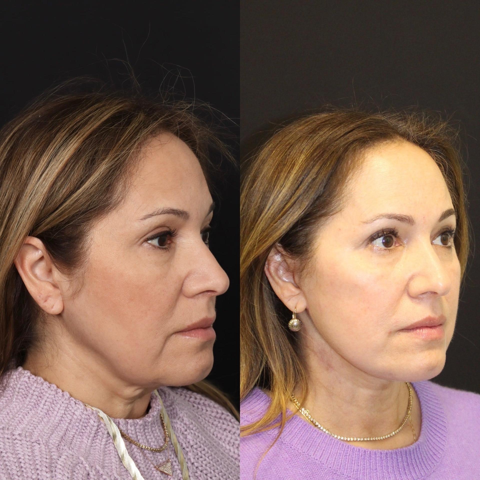 David W. Kim, MD facelift result — San Francisco, CA