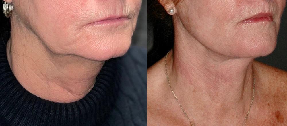 David W. Kim, MD facelift result — San Francisco, CA