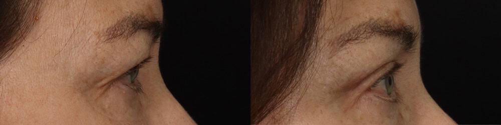 David W. Kim, MD eyelid lift result — San Francisco, CA