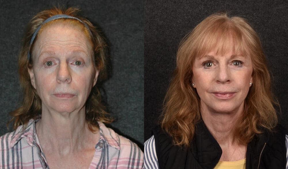 David W. Kim, MD facelift result — San Francisco, CA