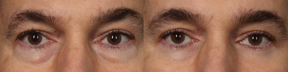 David W. Kim, MD eyelid lift result — San Francisco, CA