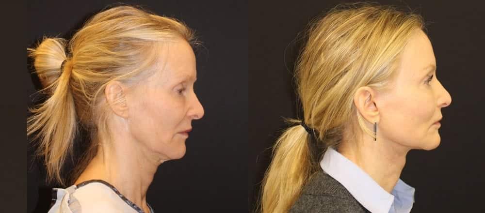 David W. Kim, MD facelift result — San Francisco, CA