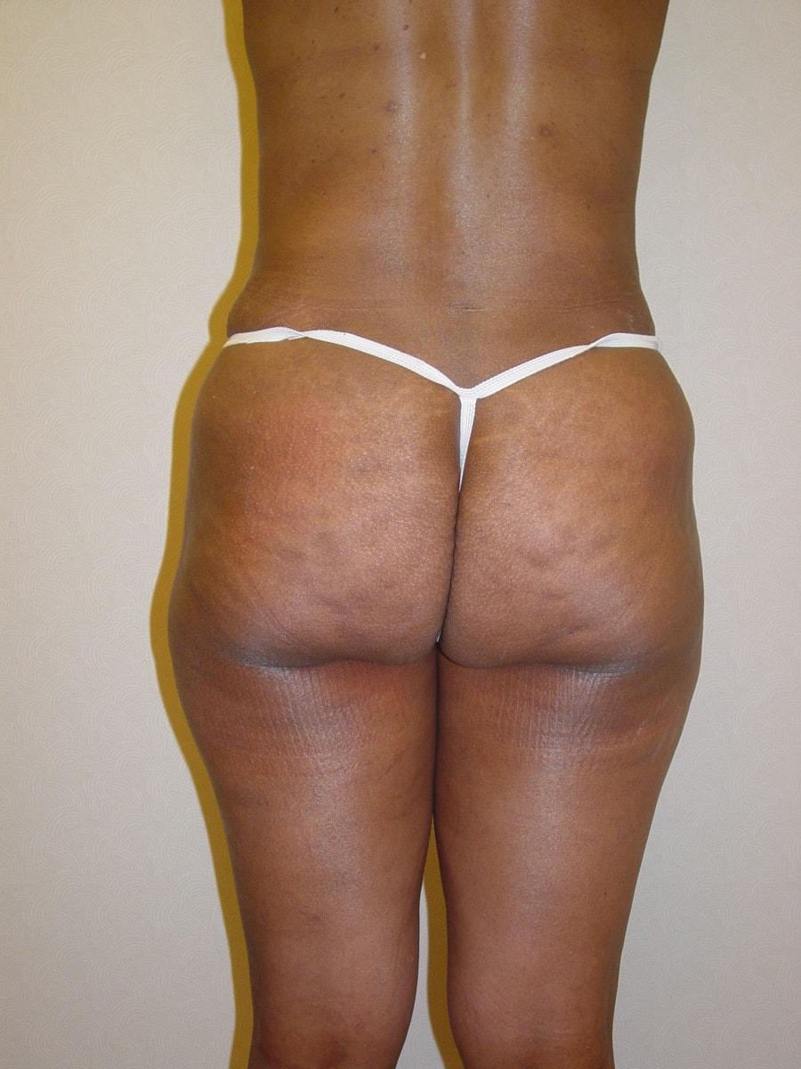 Haven J Barlow, MD liposuction after — Tysons, VA