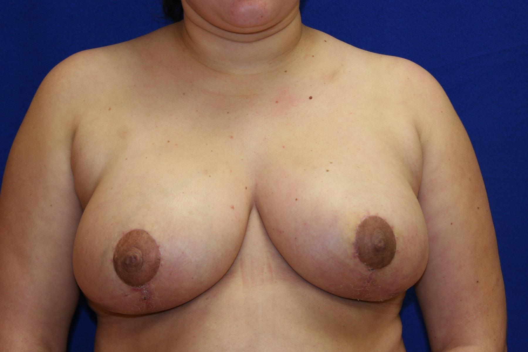 Haven J Barlow, MD breast reduction after — Tysons, VA