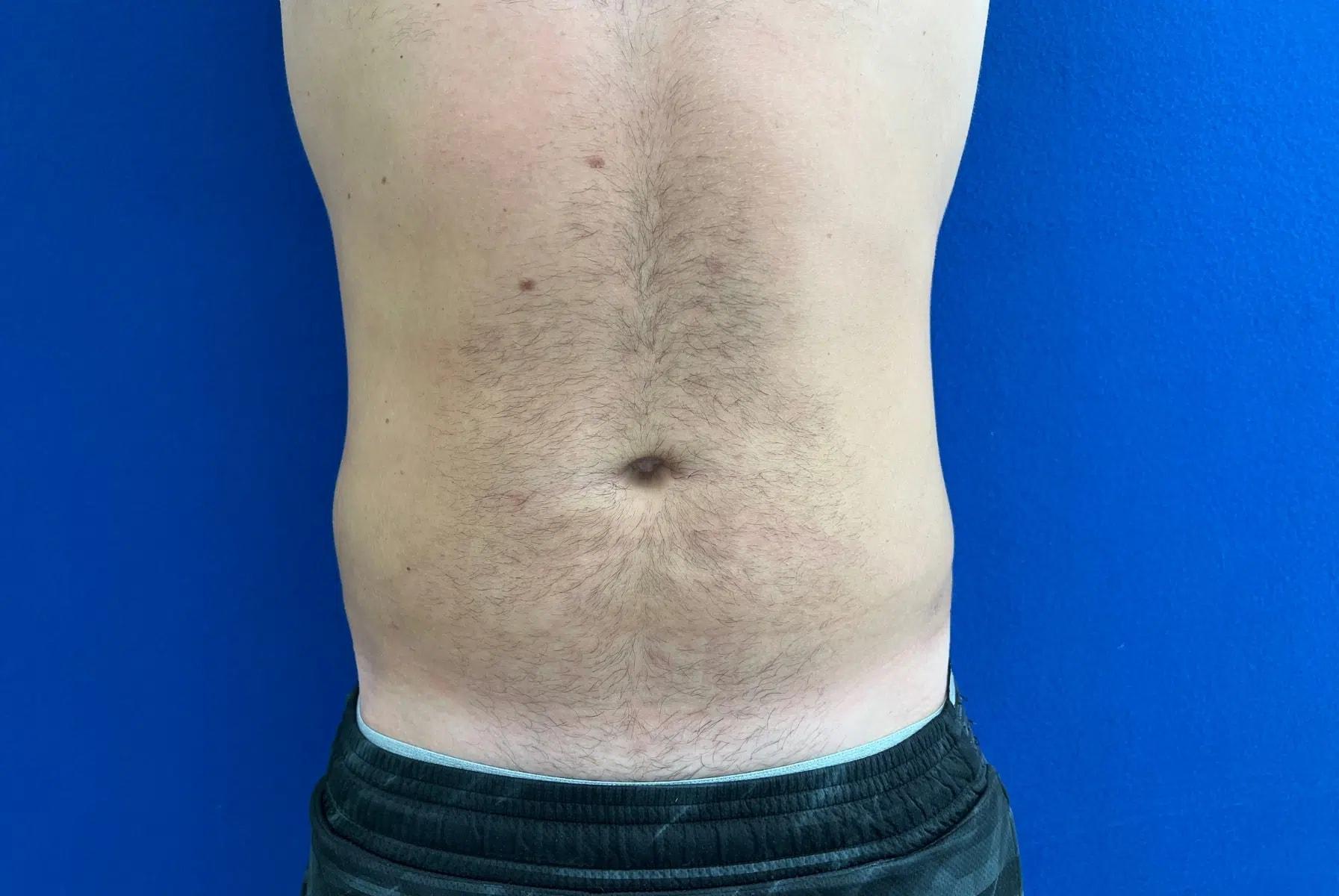 Haven J Barlow, MD liposuction after — Tysons, VA