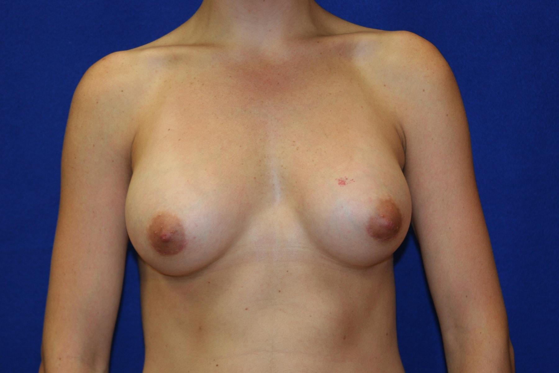 Haven J Barlow, MD breast augmentation after — Tysons, VA