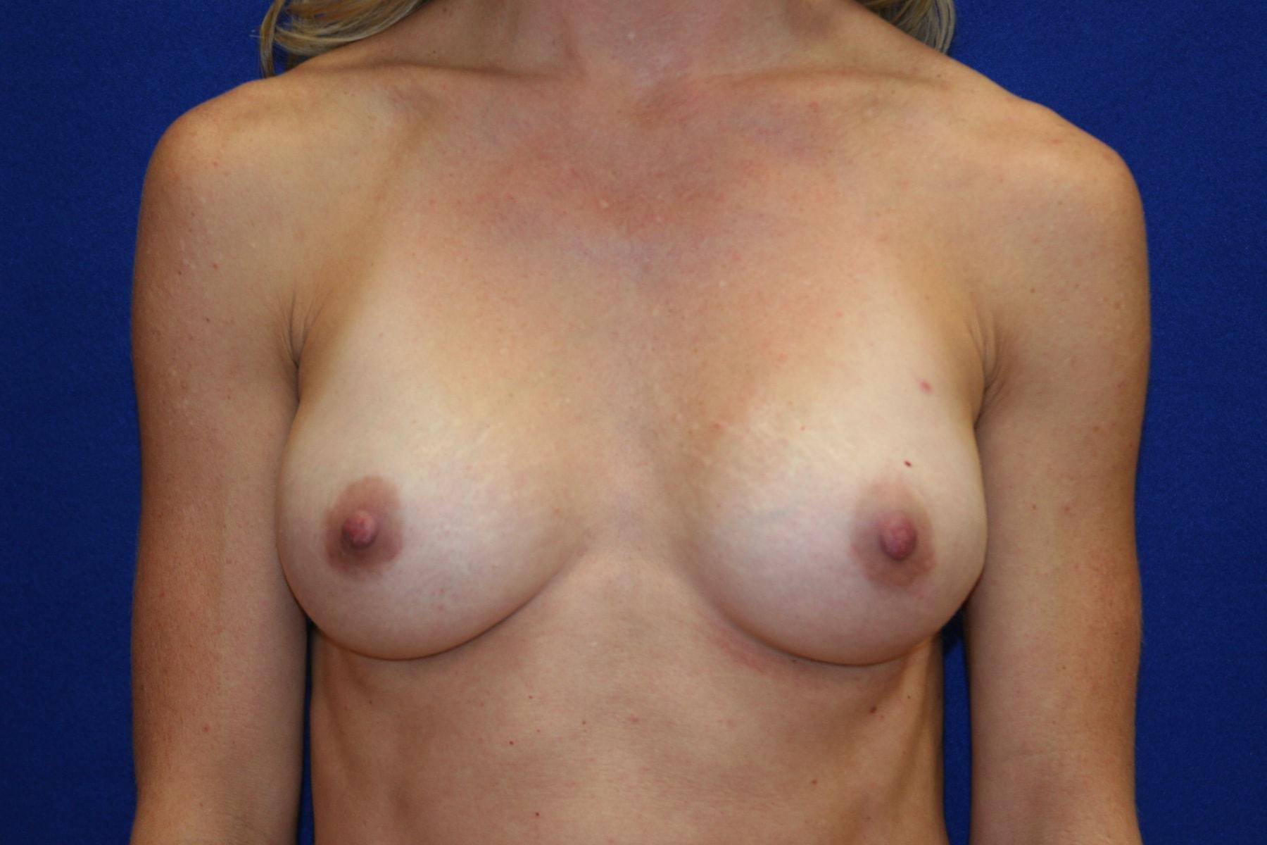 Haven J Barlow, MD breast augmentation after — Tysons, VA