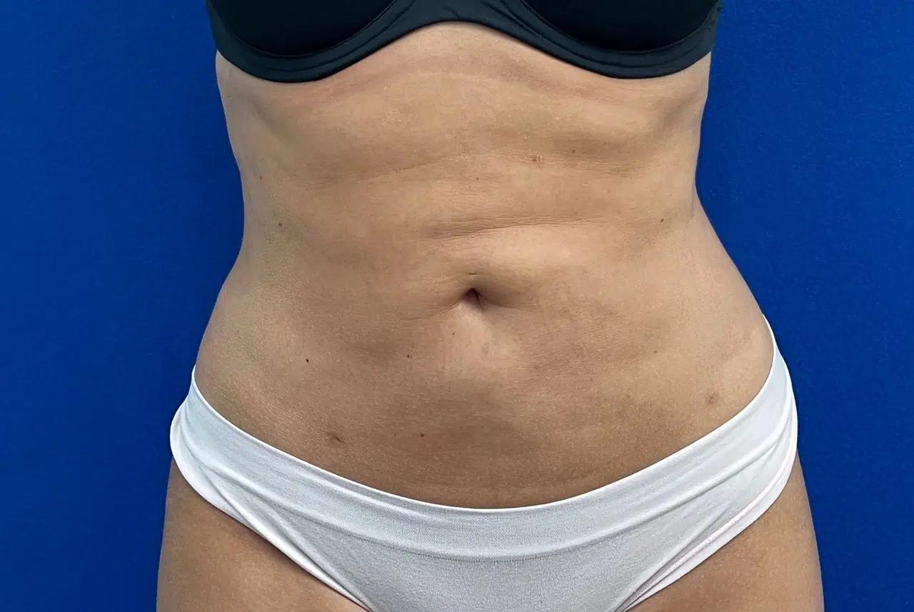 Haven J Barlow, MD liposuction after — Tysons, VA