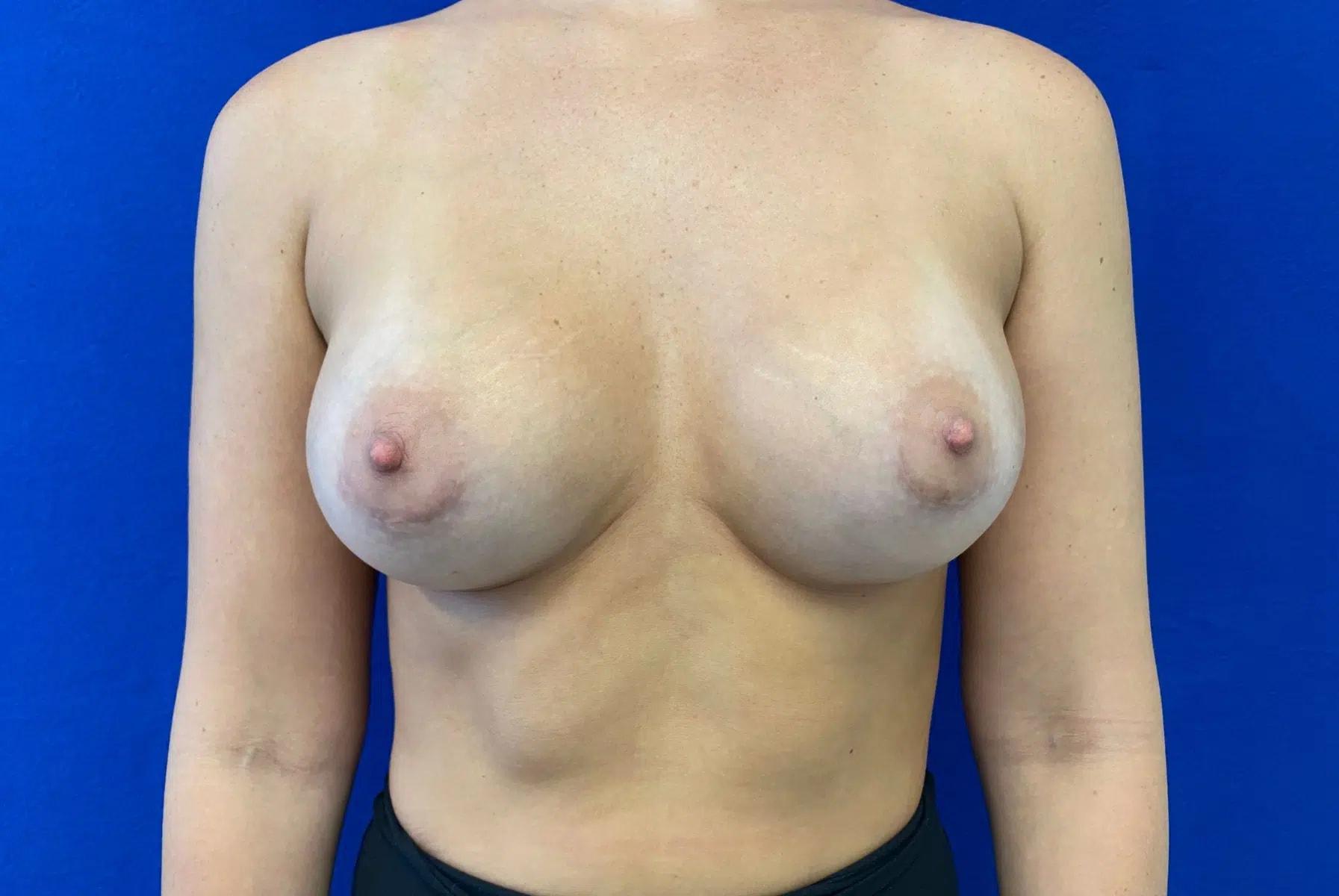 Haven J Barlow, MD breast augmentation after — Tysons, VA
