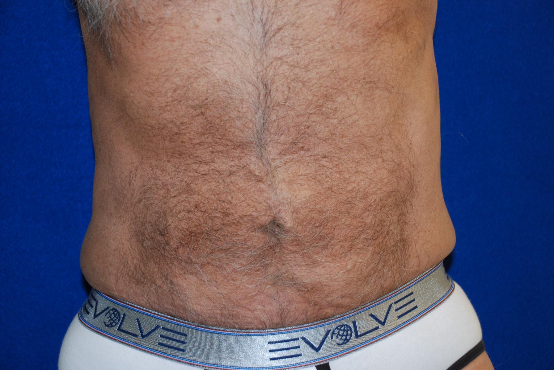 Haven J Barlow, MD liposuction after — Tysons, VA
