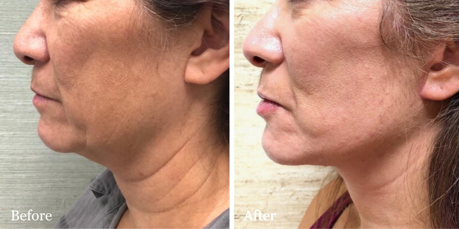 The Palm Beach Center for Facial Plastic Surgery (Jean-Paul Azzi, MD) facelift result — Jupiter, FL