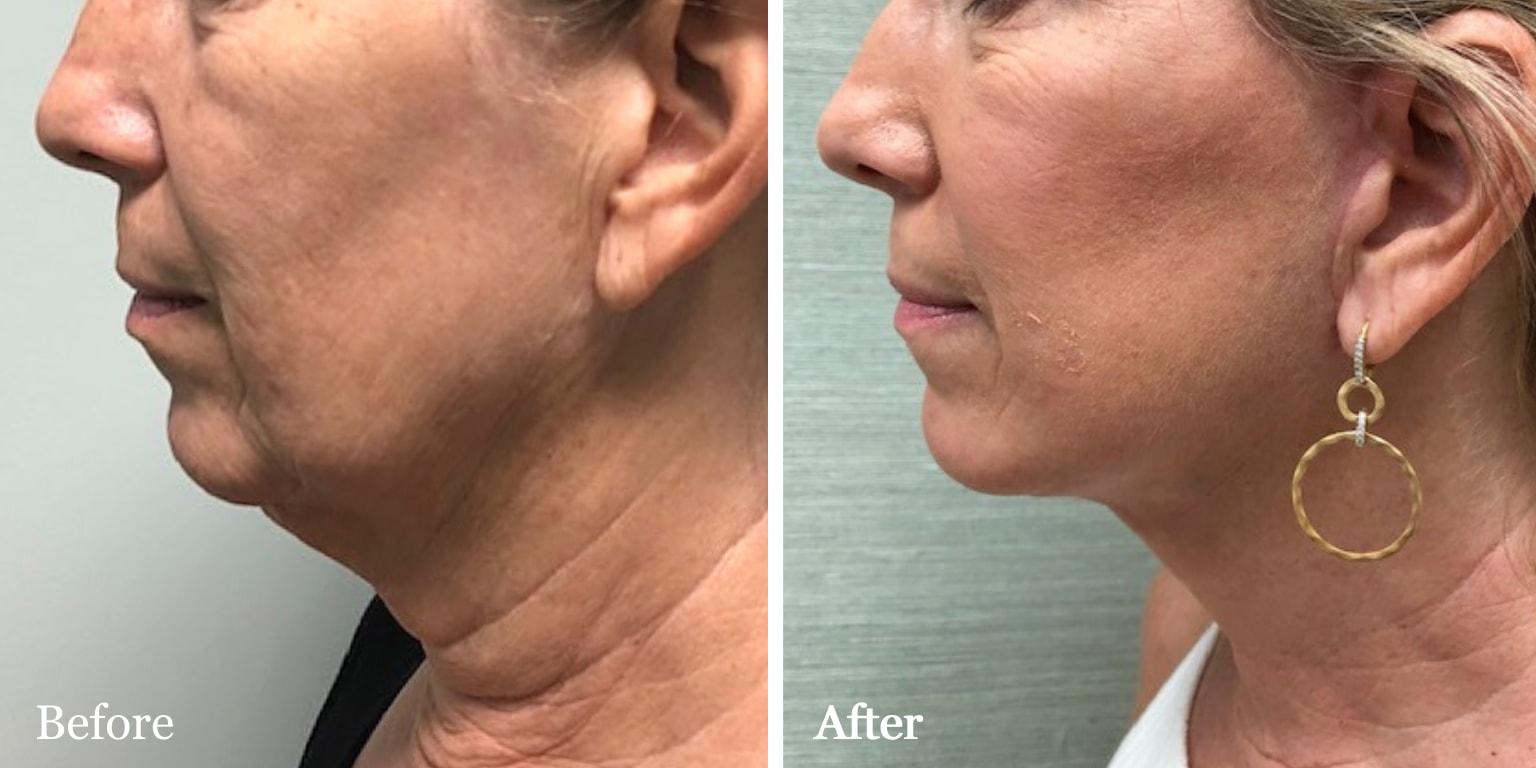 The Palm Beach Center for Facial Plastic Surgery (Jean-Paul Azzi, MD) facelift result — Jupiter, FL