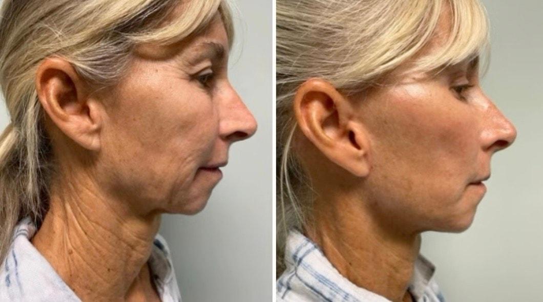 The Palm Beach Center for Facial Plastic Surgery (Jean-Paul Azzi, MD) facelift result — Jupiter, FL