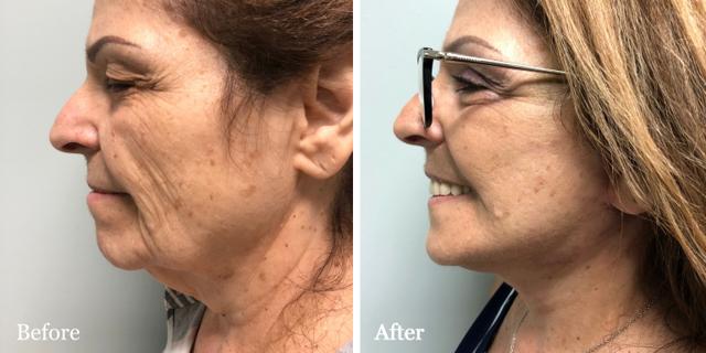 Facelift result at The Palm Beach Center for Facial Plastic Surgery (Jean-Paul Azzi, MD) in Jupiter, FL